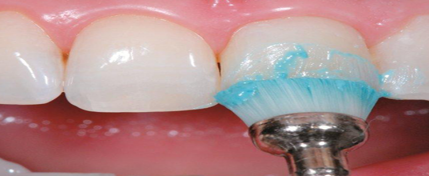 پالیش دندان (پولیش دندان) کامپوزیت چیست؟