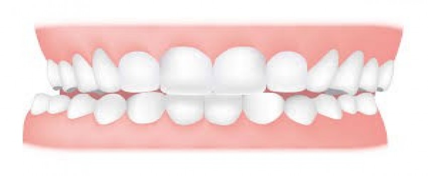 مال اکلوژن و انواع آن