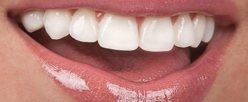 لمینت سرامیکی ایمکس