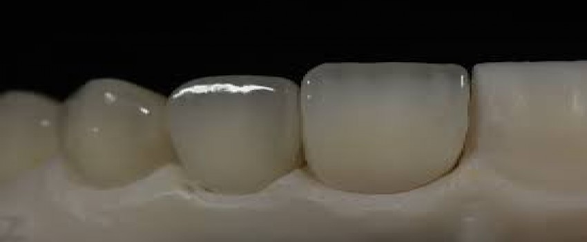 کامپوزیت روی دندان روکش شده