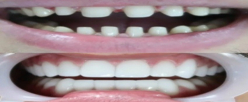 آیا برای کامپوزیت دندان را می تراشند؟