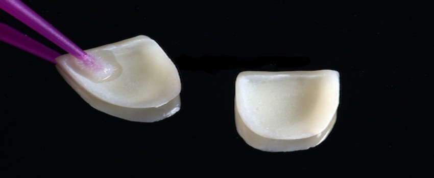 باز شدن چسب لمینت دندان