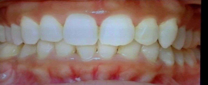 اور‌بایت و چگونگی درمان آن