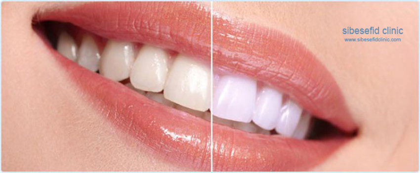 عوارض بلیچینگ دندان