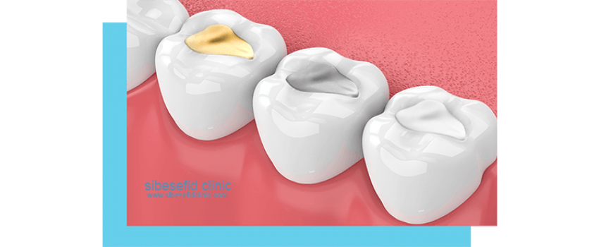 رزین کامپوزیت دندان چیست ؟ پر کردن دندان با رزین کامپوزیت