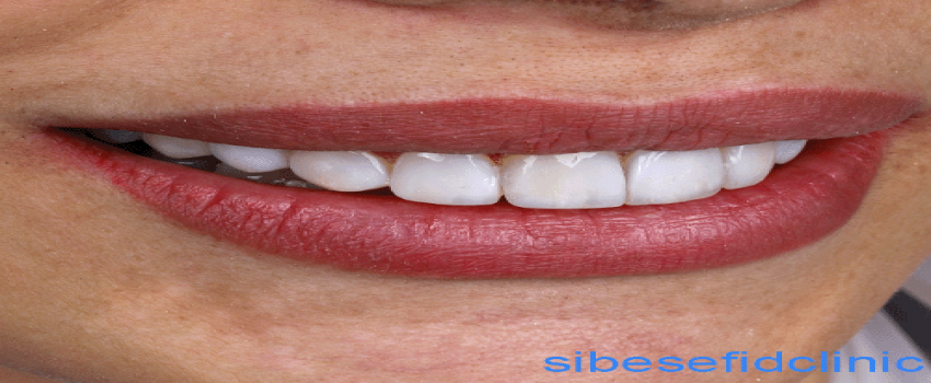 تاثیرات کامپوزیت بر زیبایی دندان
