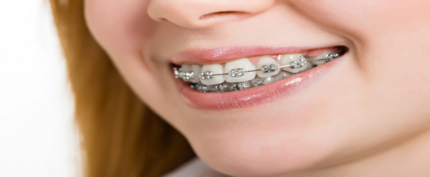ارتودنسی با براکت‌های فلزی و مزایای آن