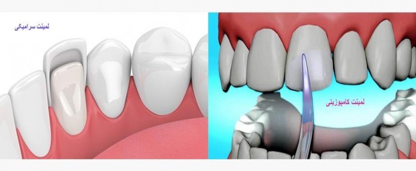 تفاوت لمینت سرامیکی و کامپوزیتی