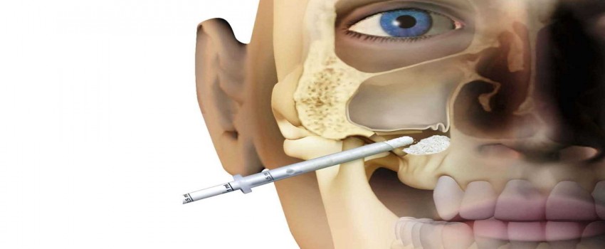 سینوس لیفت یا جراحی بالابردن سینوس چیست؟